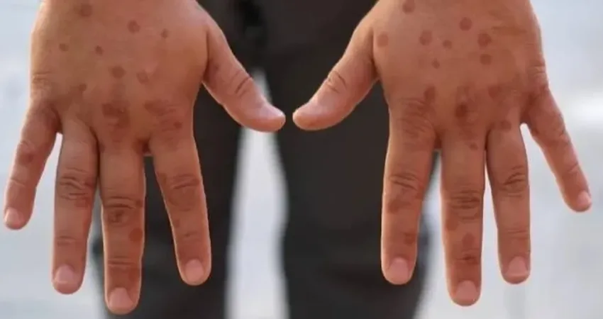 Uzmanlar Maymun çiçeği hastalığının, Orthopoxvirus ailesine ait bir virüs türüdür