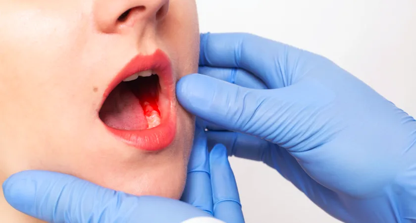 Ağız Kokusu Neden Olur? Ağız kokusunun nedeni solunum yolu enfeksiyonları da olabilir! Ağız kokusu