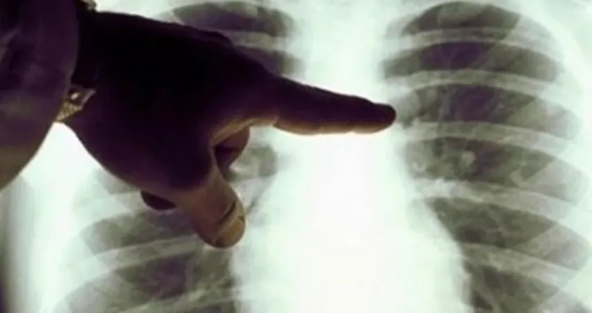 Kanser, dünyada en sık görülen hastalıklardan biri. Akciğer kanseri de