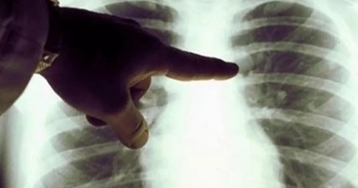 Kanser, dünyada en sık görülen hastalıklardan biri. Akciğer kanseri de