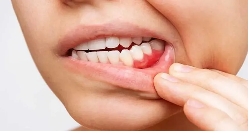 Diş eti çekilmesinin diş köklerinin açığa çıkması durumu olduğunu belirten