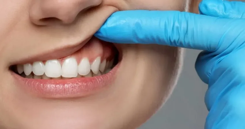 Diş eti çekilmesinin başlıca nedeninin diş taşı birikimi olduğunu belirten