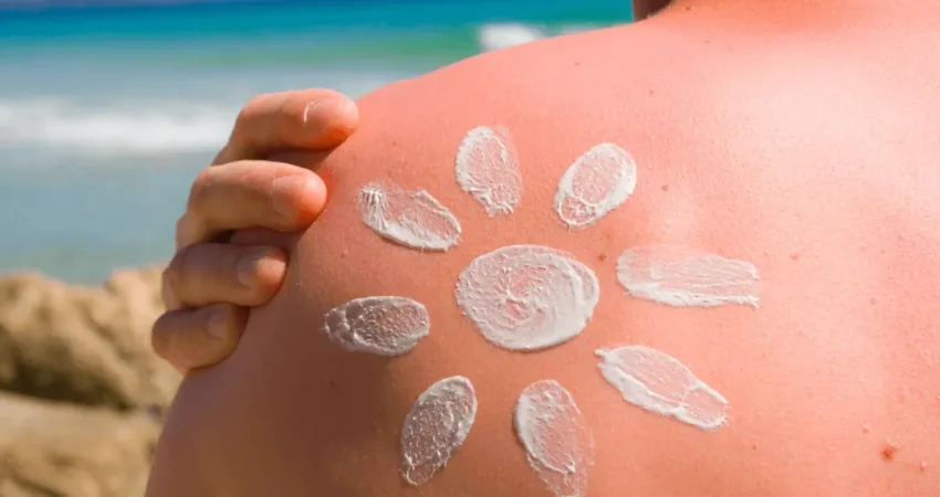 Dermatoloji Uzmanı Dr. Burcu Barutcugil, yaz mevsiminde artan güneş yanığı