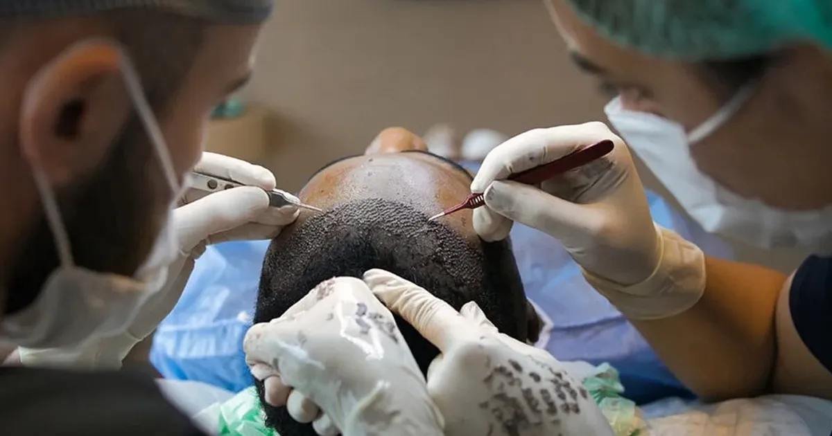 Sağlık Bakanlığı, Saç Ekimi Birimleri Hakkında Yönetmelik’te değişiklik yaptı. Bugünkü
