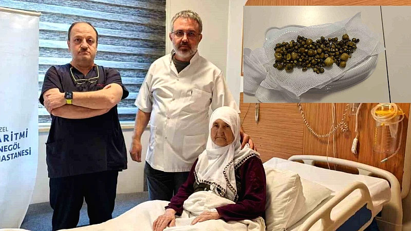 Bursa'nın İnegöl ilçesinde 77 yaşındaki Zülfinaz Korkmaz, safra kesesindeki 213