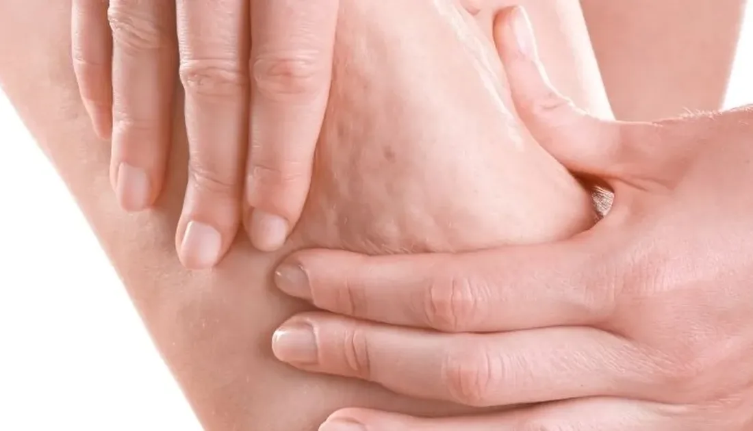 Estetik ve Plastik Cerrahi Uzmanı Prof. Dr. Ahmet Karacalar, selülitin