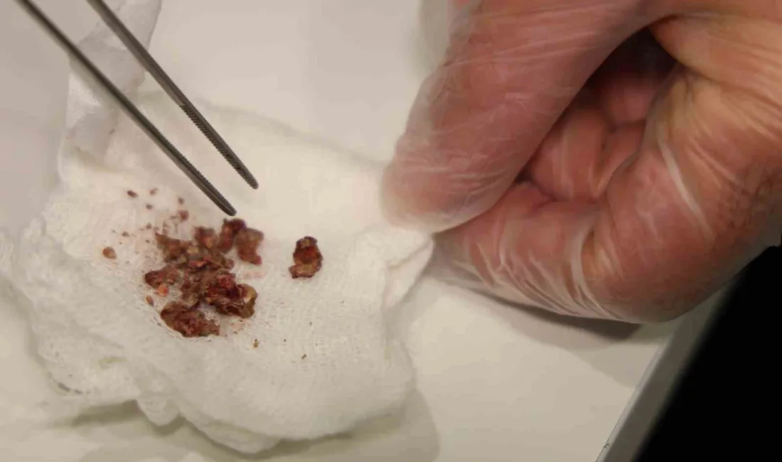 Elazığ'da burun estetiği için ameliyat olan bir hastanın burnunda, KBB