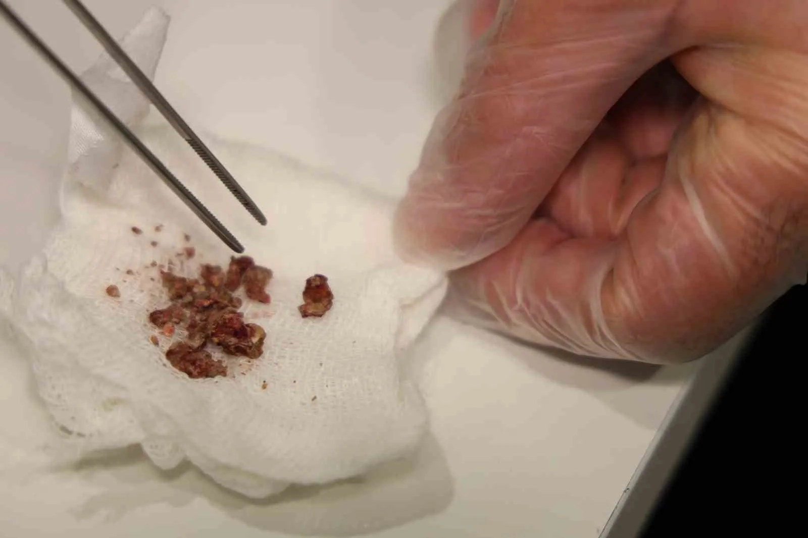 Elazığ'da burun estetiği için ameliyat olan bir hastanın burnunda, KBB