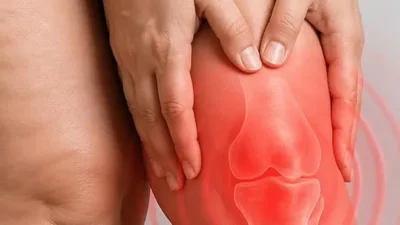 Prof. Dr. Ahmet Karacalar, lipödemin diz eklemlerinde yük artışı ve